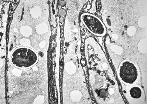 F,1m. | sepsis … mycotic skin lesions F,1m. | sepsis … mycotic skin lesions